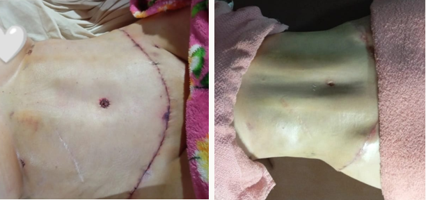 Comparativo antes e depois de pós-operatório de lipoaspiração